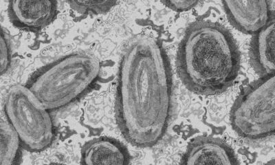 kasus pertama infeksi virus shamonda pada manusia